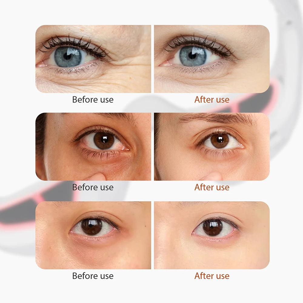 Anti-Dark Circle Therapy Device